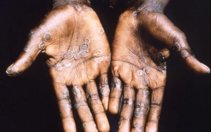 Small chance of monkeypox here, but be careful, says health ministry